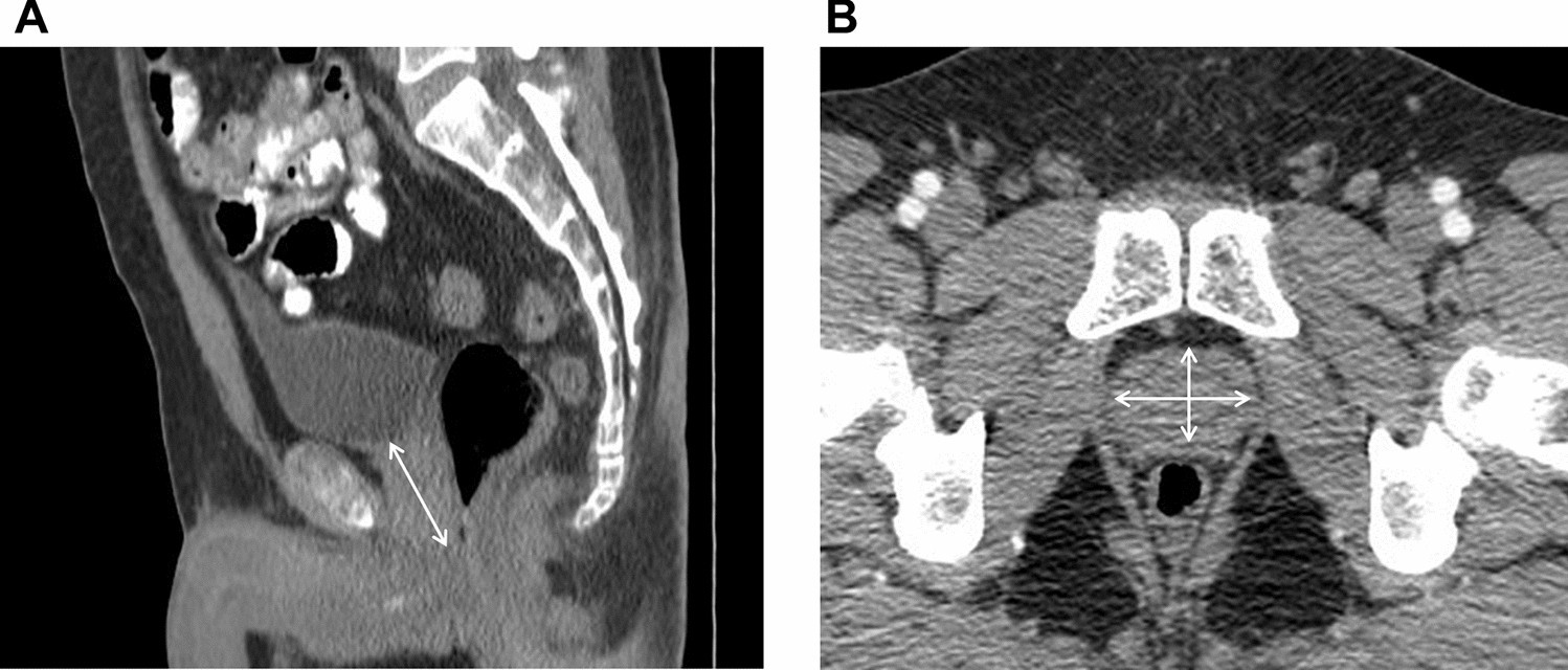 Prostate volume on computed tomography correlates well with magnetic resonance imaging measurements and is reproducible across rater training levels