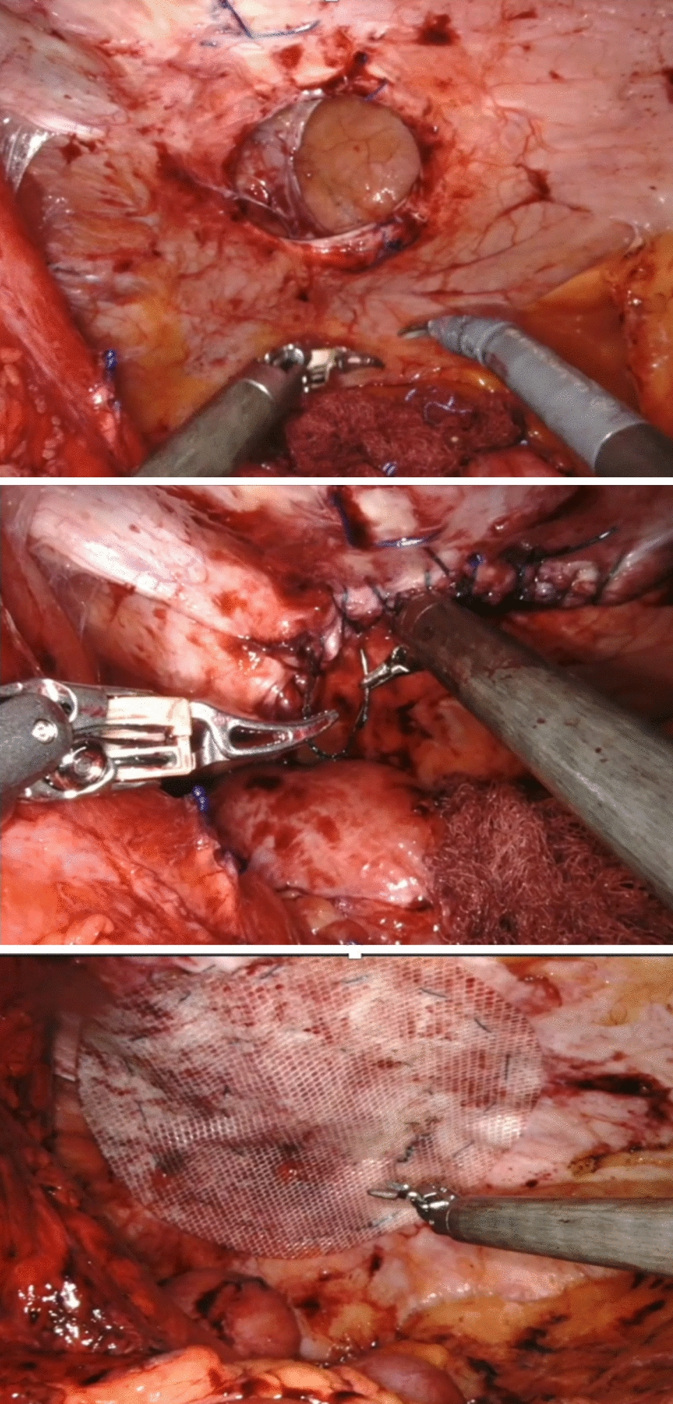 Robotic Ventral Hernia Repair: Indications and Outcomes