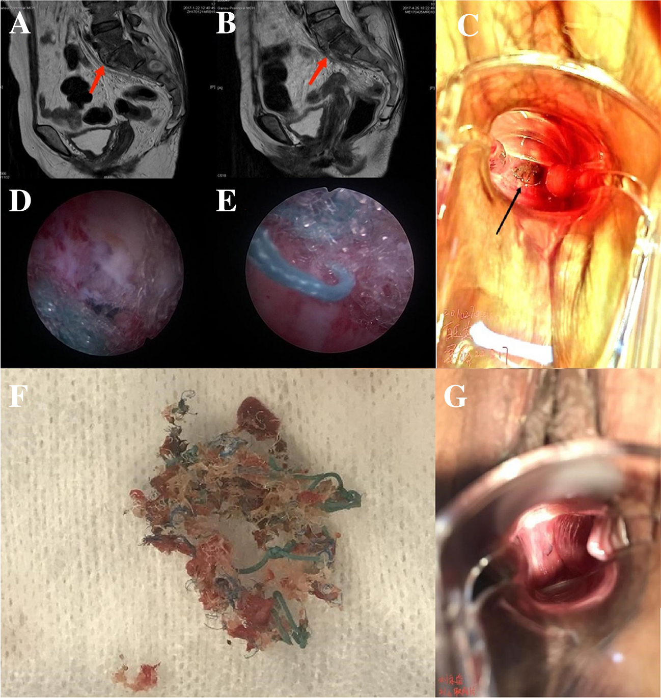 Utilizing Hysteroscopic Mesh Resection for Presacral Mesh Infection Following Sacrocolpopexy