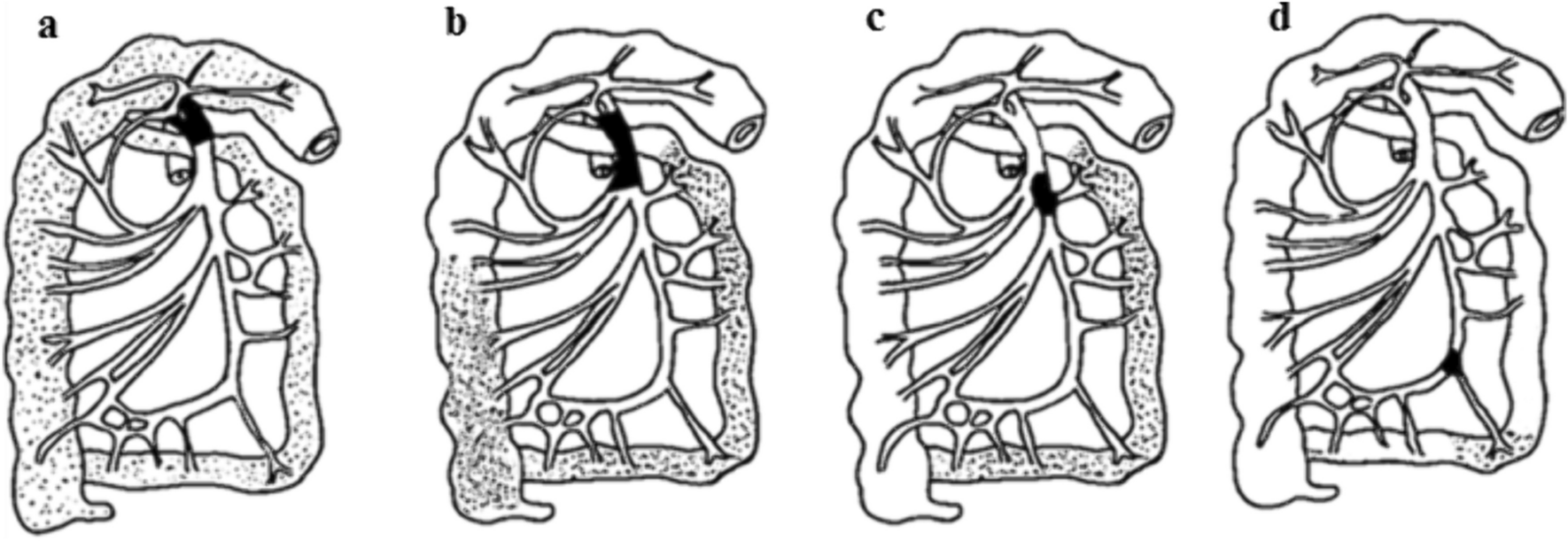 Clinico-Radiological Features of Acute and Chronic Superior Mesenteric Artery Occlusion (SMAO)