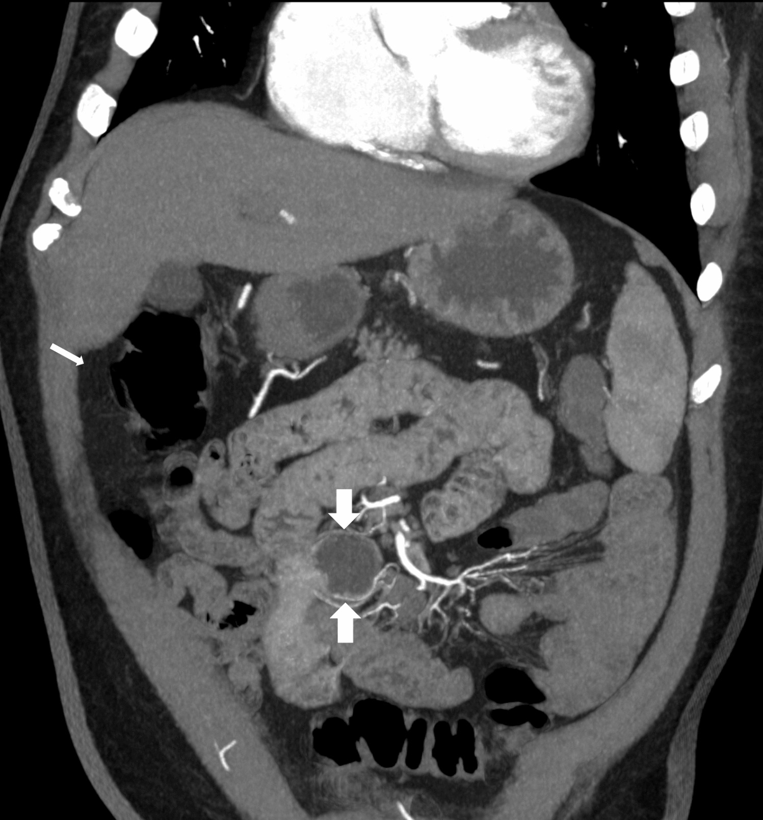 Bleeding Jejunal Diverticula: Always a Timely Reminder