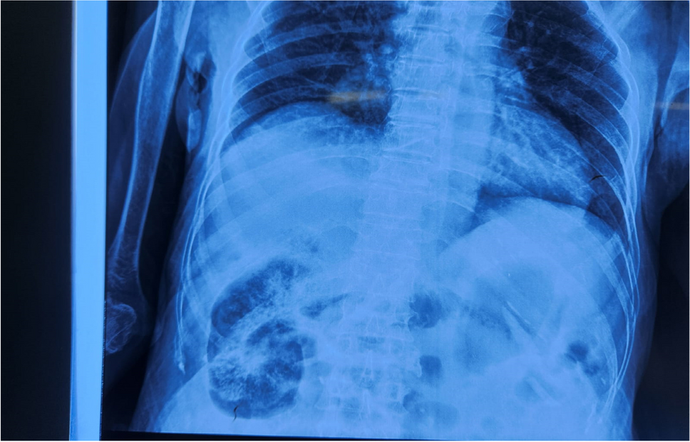 Emphysematous Pyelonephritis on X-ray Abdomen