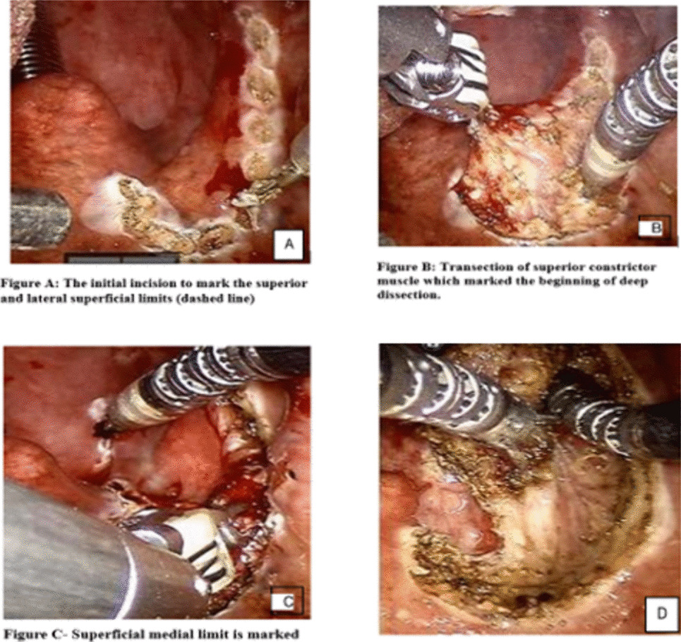 Execution of Ipsilateral Radical Tonsillectomy and Tongue Base Mucosal Wedge Biopsy with Trans Oral Robotic Surgery (TORS) in the Setting of Carcinoma Unknown Primary (CUP): Insights into Surgical Techniques and Instrumentation