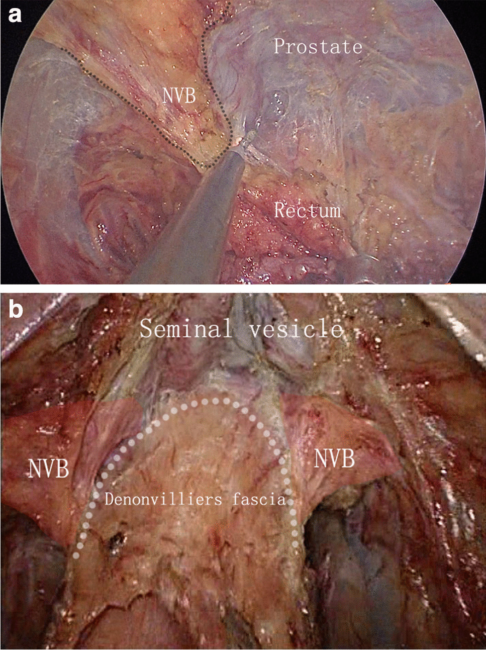 Comparison of Urogenital Functions after Transanal and Laparoscopic Total Mesorectal Excision