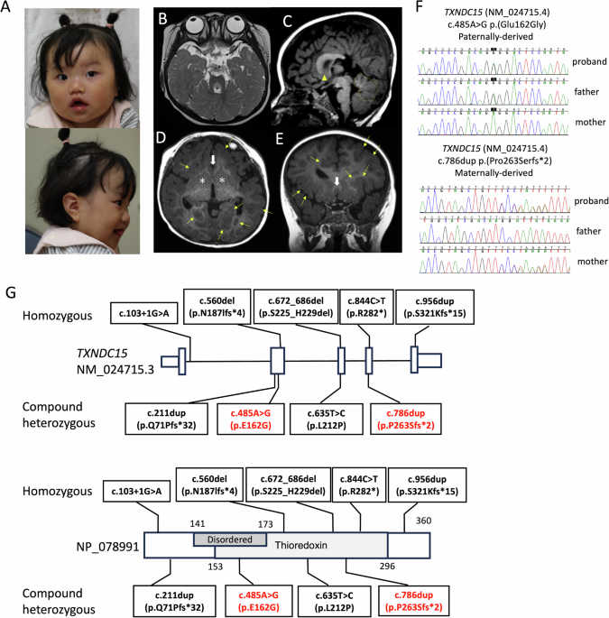 Biallelic TXNDC15 variants associated with Joubert syndrome-related molar tooth sign and forebrain malformation