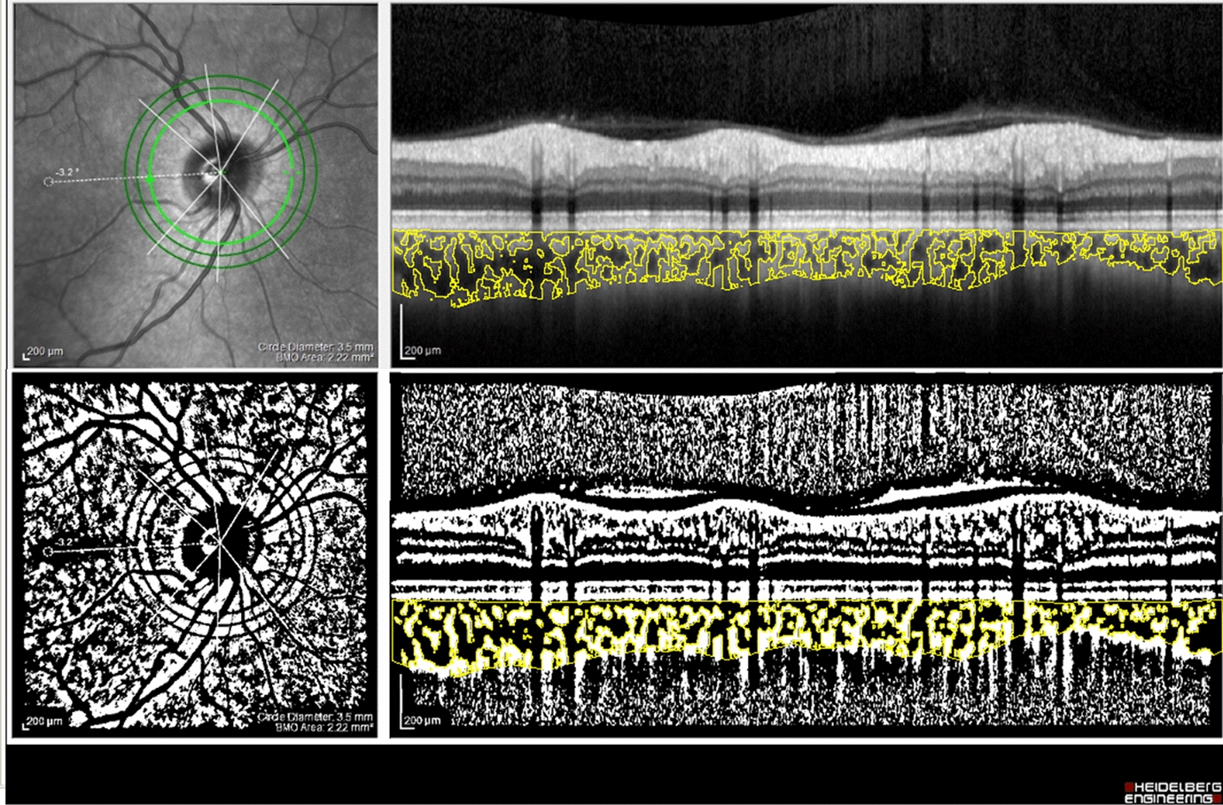 Is there a relationship between the keratoconus and the peripapillary choroidal vasculature?