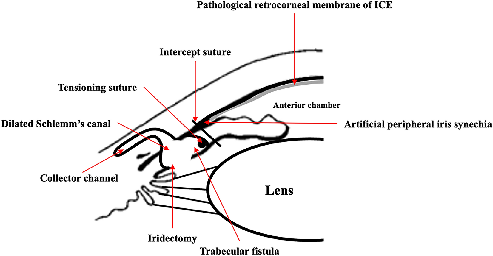 Retrocorneal membrane interception enhanced penetrating canaloplasty for patients with open angle glaucoma secondary to ICE syndrome