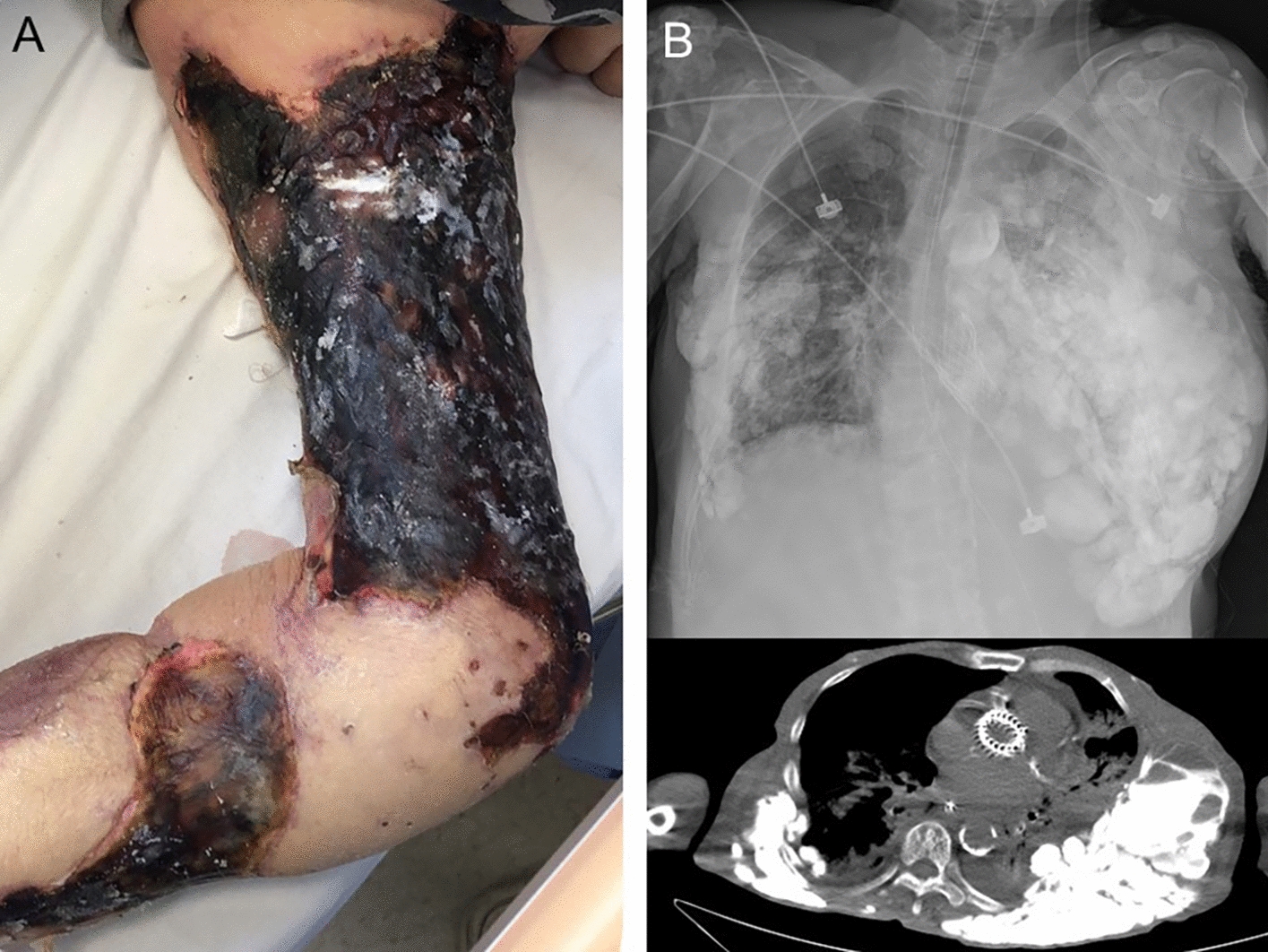 Calciphylaxis and metastatic calcification