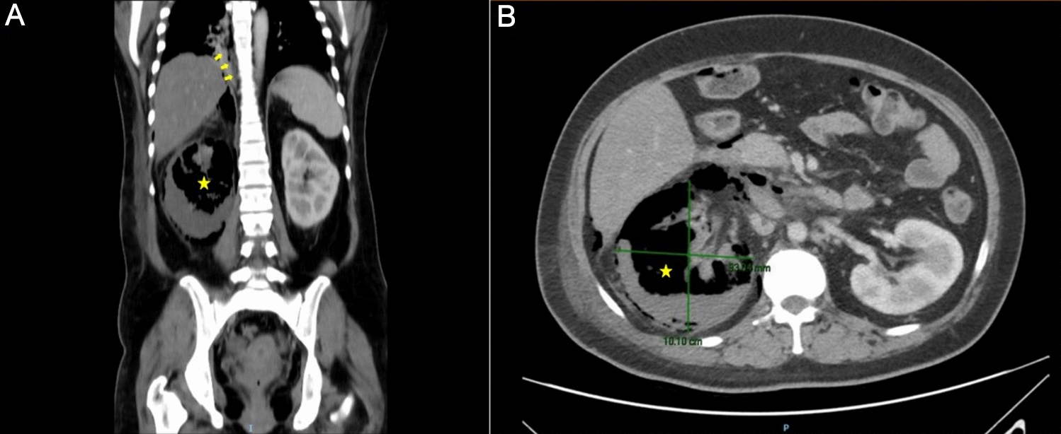 Nephrology picture: Emphysematous pyelonephritis complicated with pneumomediastinum