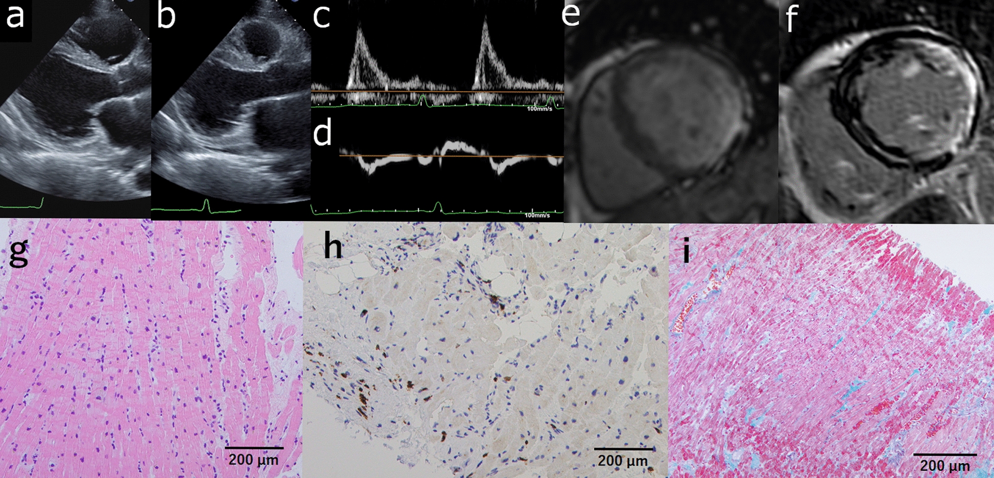 Cardiomyopathy with anti-mitochondrial M2 antibody-positive myositis