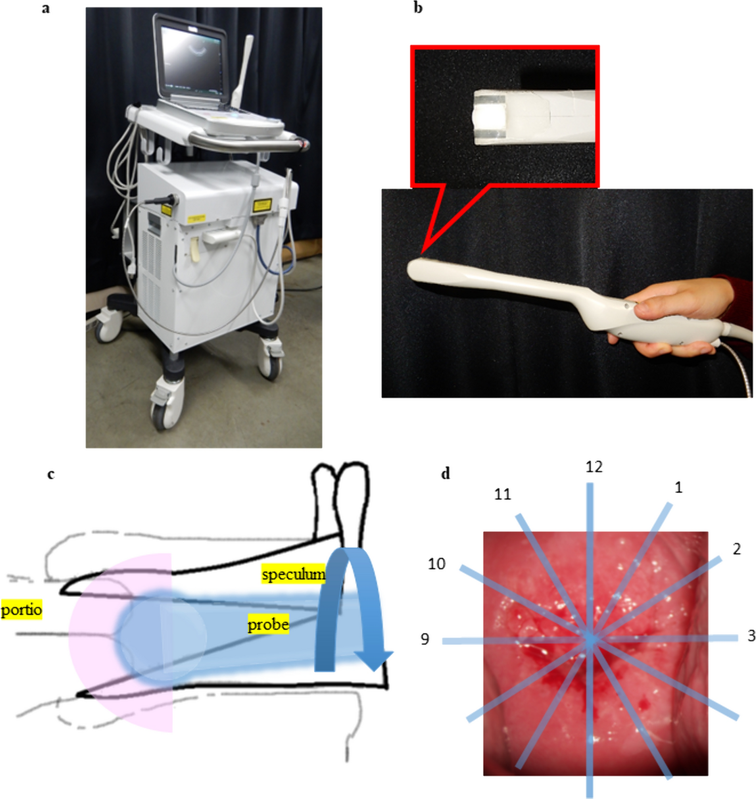 Clinical application of photoacoustic imaging for cervical precursor lesion detection