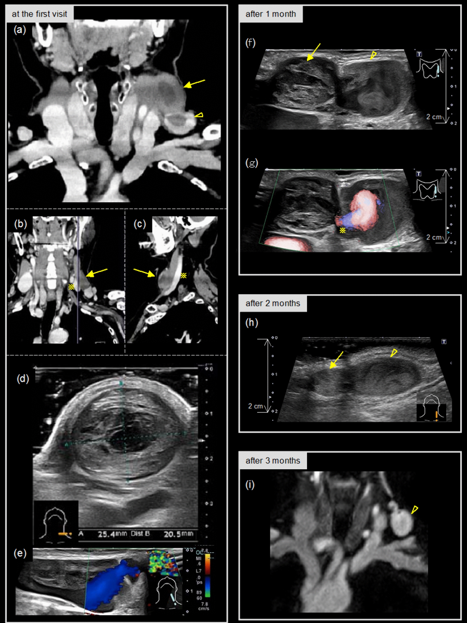 Resolution of oval thrombus in a case of external jugular venous aneurysm