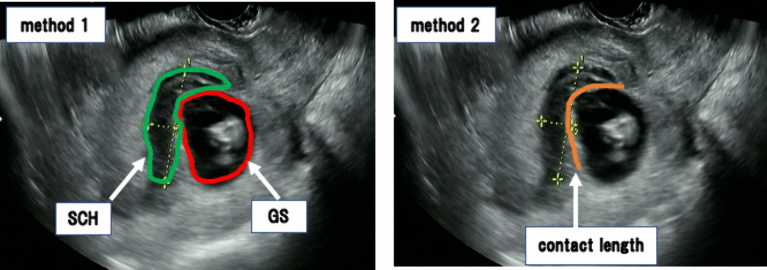 Quantification of the size of subchorionic hematoma causing pregnancy-related complications: a retrospective cohort study