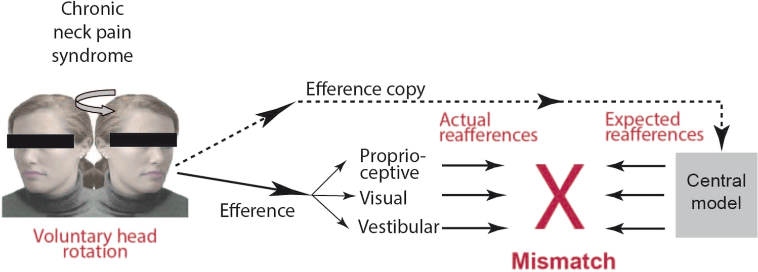 Impact of proprioceptive cervical dizziness in chronic neck pain syndromes on gait and stance during active head-turn challenges