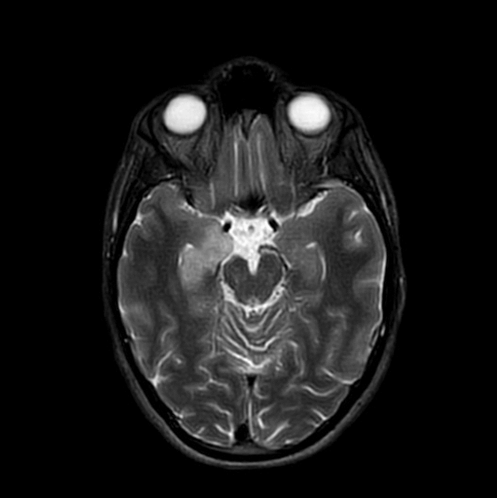 POLG-related mitochondrial disease mimicking autoimmune encephalitis