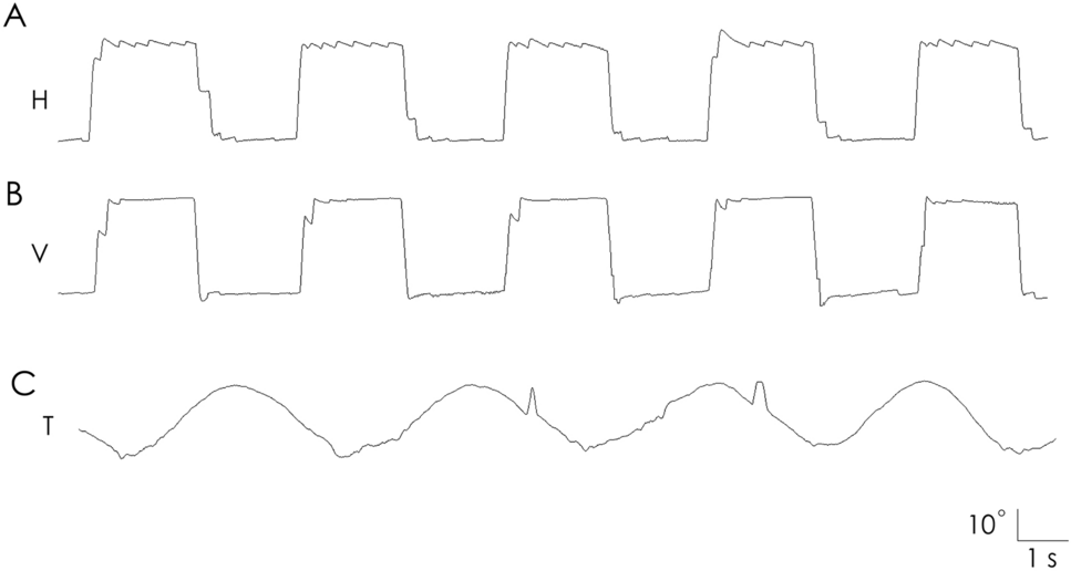 Torsional saccadic palsy in episodic ataxia type 2