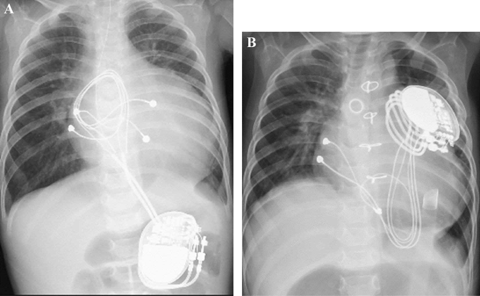 Mechanical support for bridge to transplant in an infant with post-cardiotomy end-stage heart failure and complete heart block: report of a case