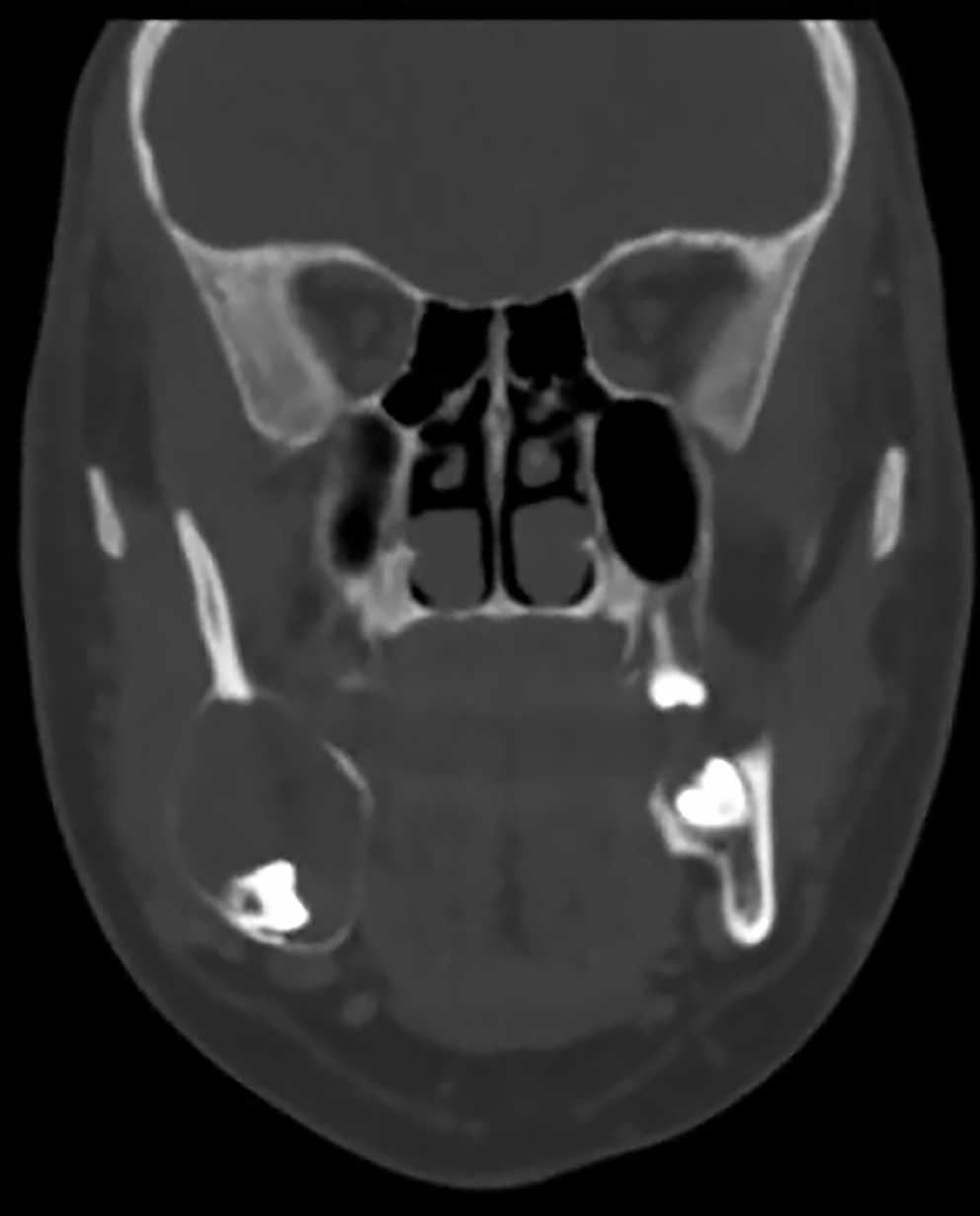 Primordial Odontogenic Tumor: A Decade Post-Description Systematic Review