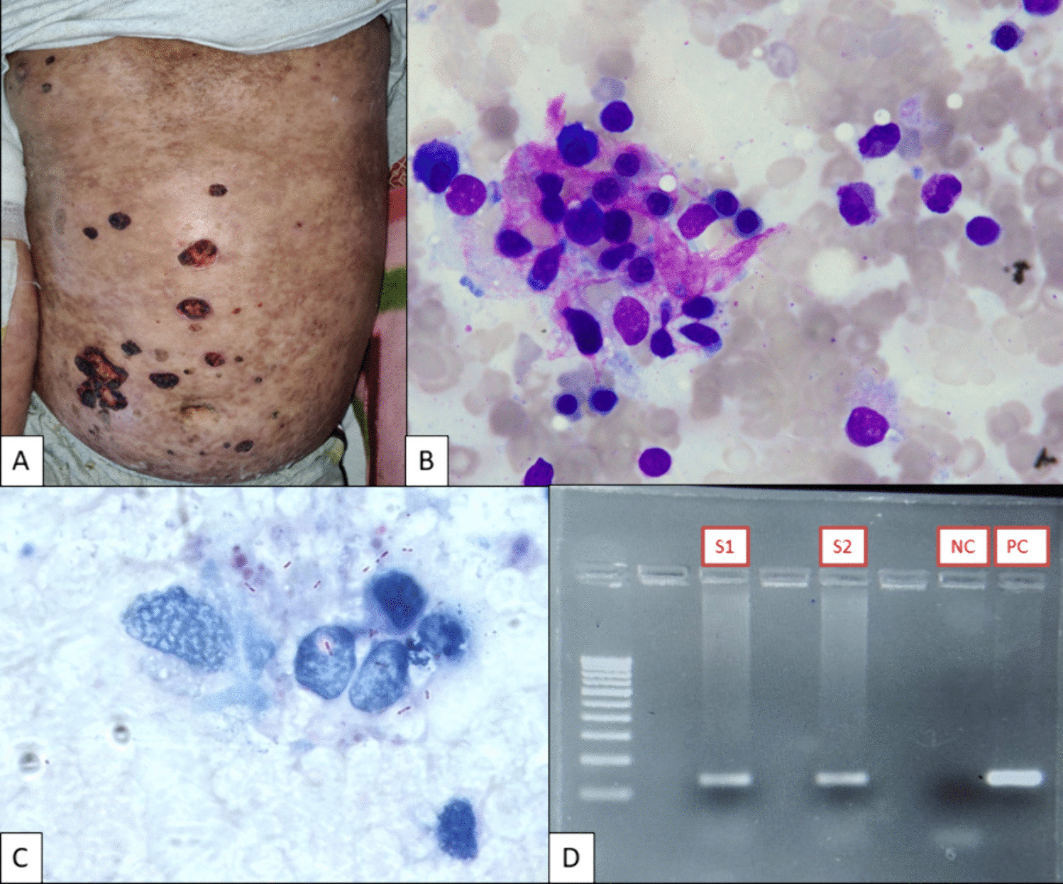 Bridging dermatology and hematology: a case of lepromatous leprosy with bone marrow involvement and pancytopenia