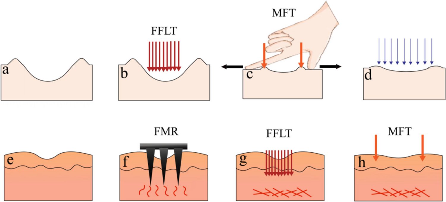 Effectiveness and safety of the modified multiple mode procedures versus traditional multiple mode procedures on treating facial atrophic acne scars: a propensity score matching retrospective cohort study