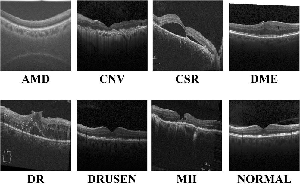 Multi-resolution visual Mamba with multi-directional selective mechanism for retinal disease detection