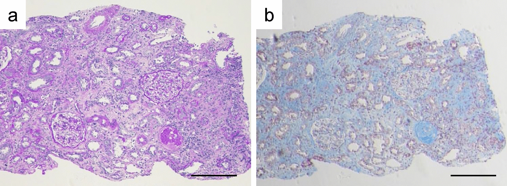 Case of successful treatment with glucocorticoid for isolated anti-centromere antibody-positive acute interstitial nephritis