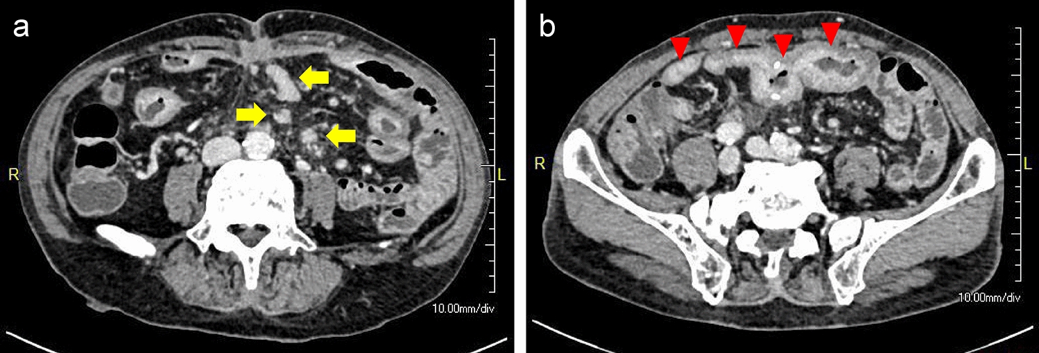 Relapsing sclerosing mesenteritis with multiple strictures of the small intestine