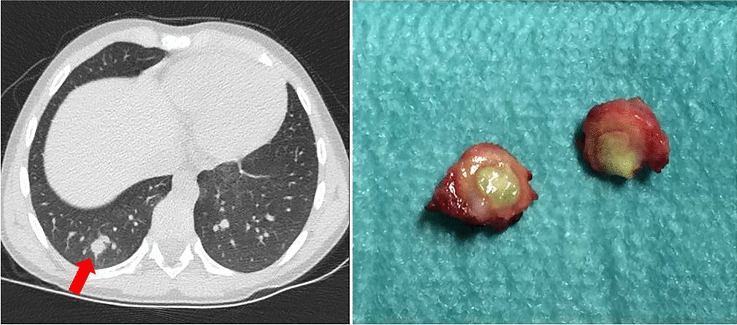 Surgical treatment of invasive pulmonary fungal infections in immunocompromised pediatric patients: Aspergillus spp. and other emerging fungi