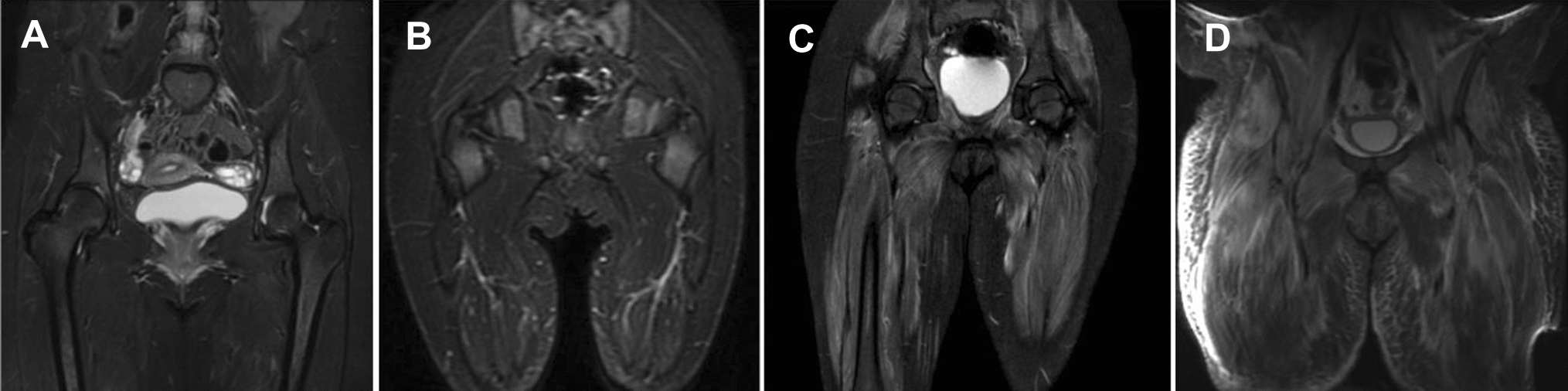 Risk factors for developing calcinosis in juvenile dermatomyositis: subcutaneous and myofascial edema in initial magnetic resonance imaging