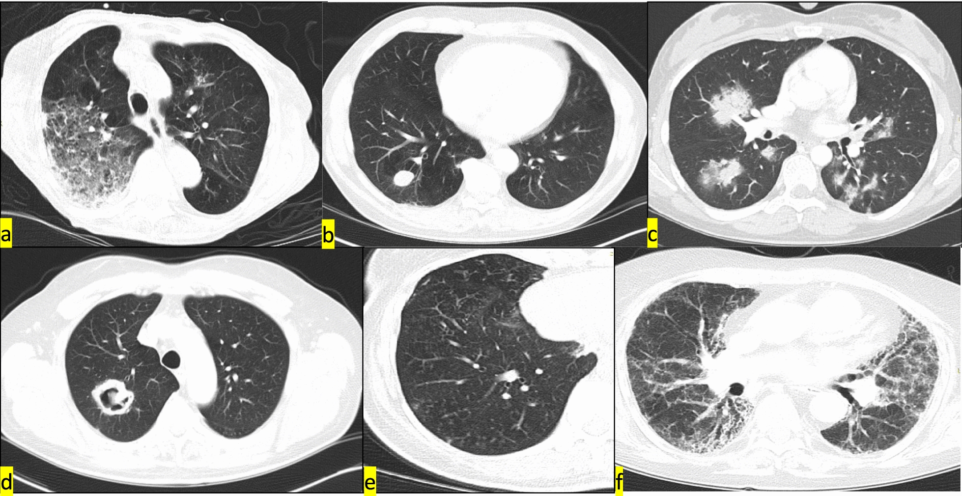 Distinct pulmonary patterns in ANCA-associated vasculitides: insights from a retrospective single center cohort study