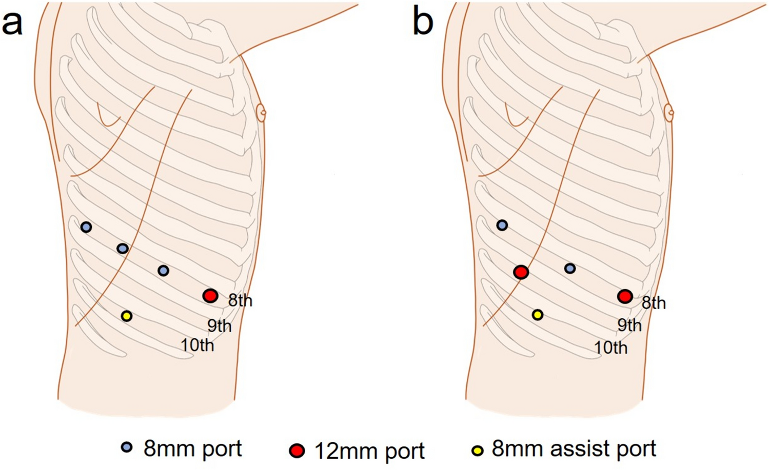 Effective division of the intersegmental plane using a robotic stapler in robotic pulmonary segmentectomy