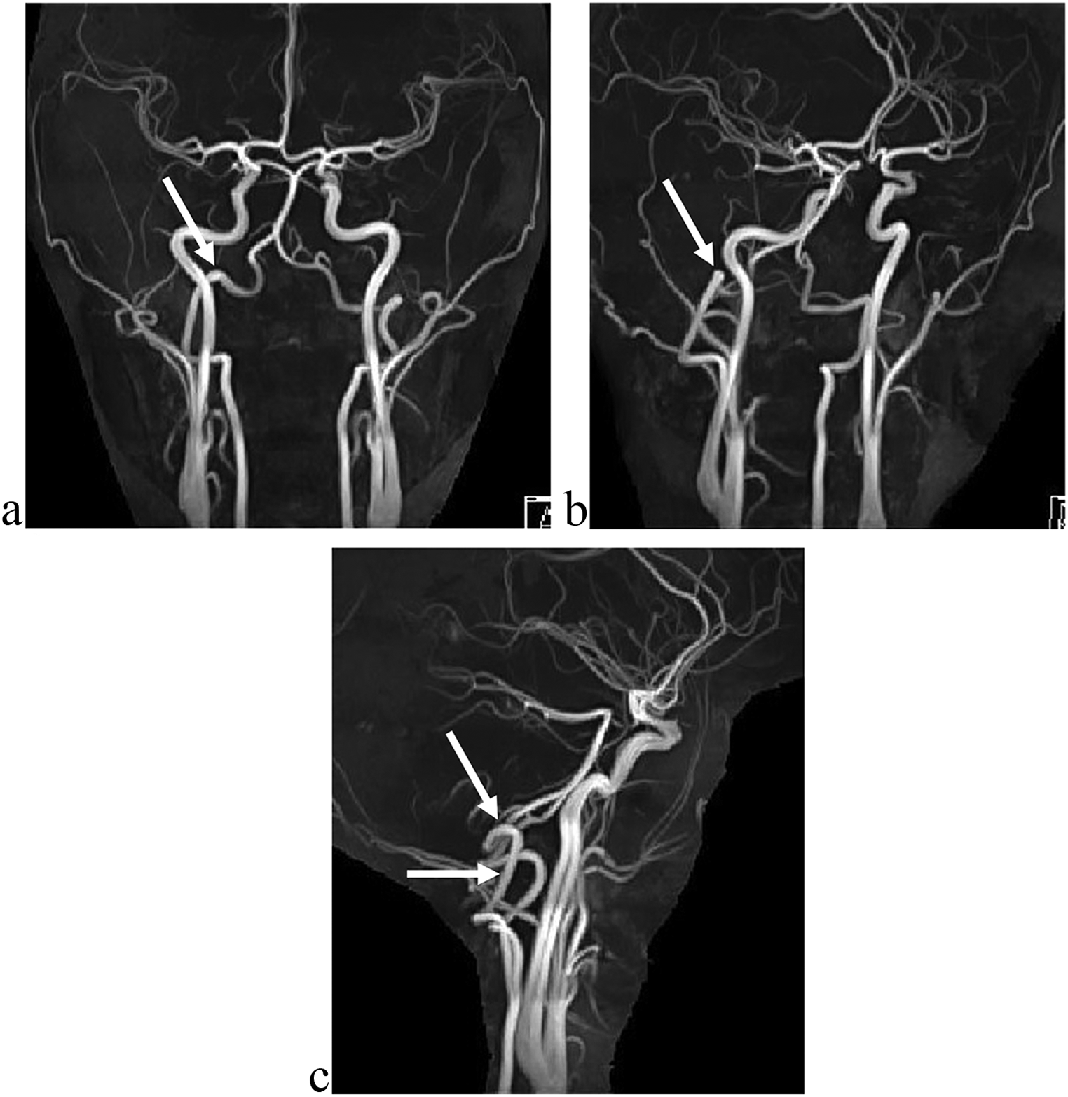 V3 segment of the right vertebral artery taking an anomalous posterosuperior course and penetrating occipital bone (wall of the jugular foramen) diagnosed by magnetic resonance angiography