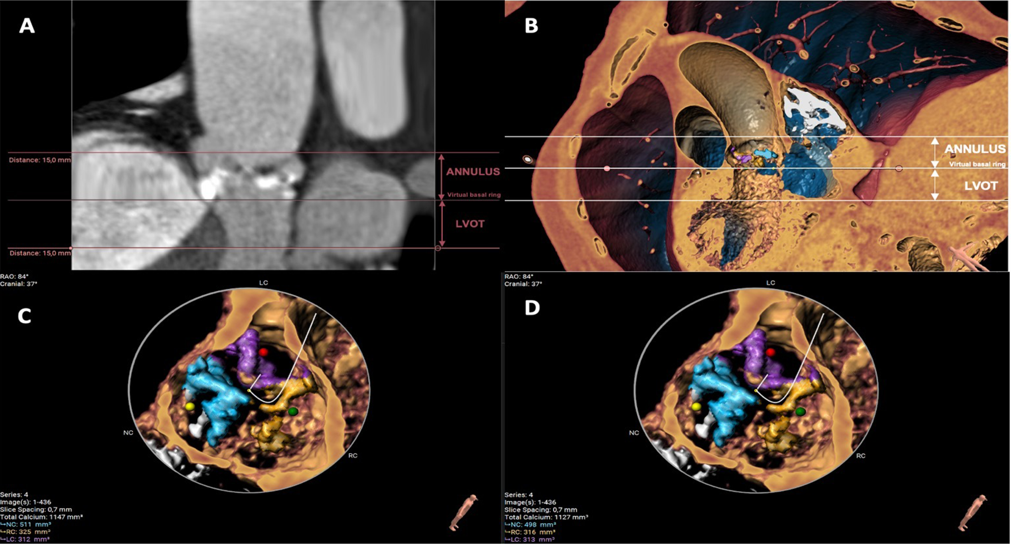 Impact of burden and distribution of aortic valve calcification on the hemodynamic performance and procedural outcomes of a self-expanding, intra-annular transcatheter aortic valve system