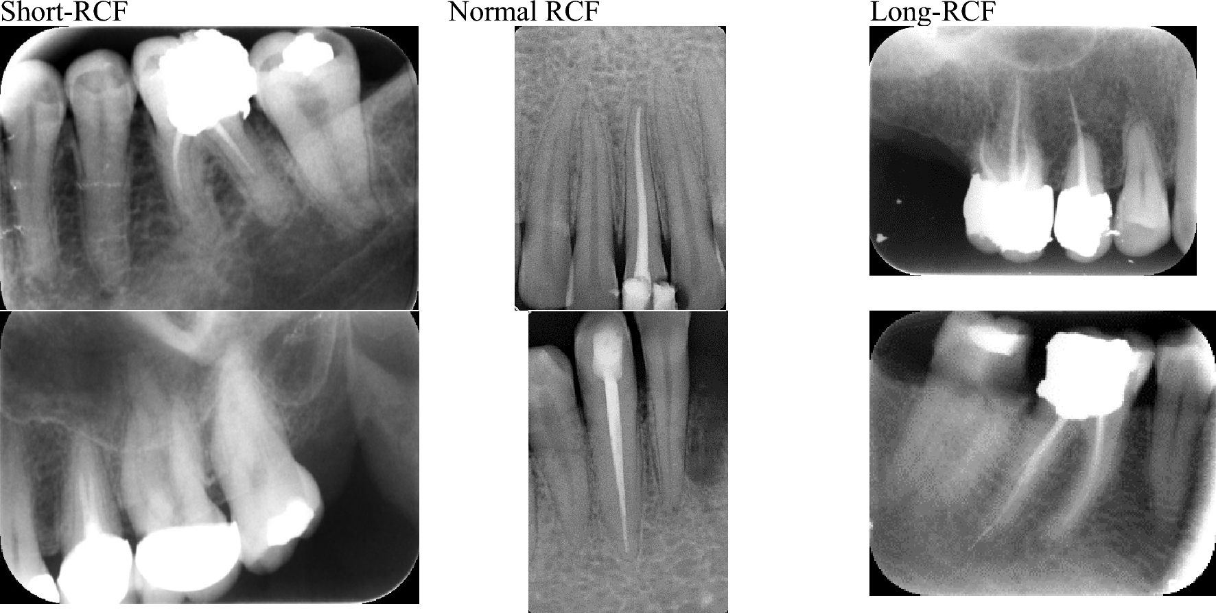 Evaluation of root canal filling length on periapical radiograph using artificial intelligence