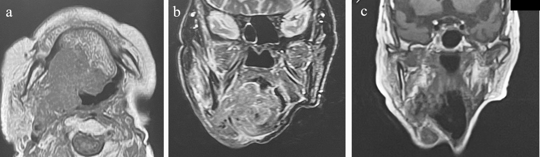 Combined external radiotherapy and single-fraction palliative high-dose-rate interstitial brachytherapy for a patient with a base of tongue cancer who had a previous radiation history