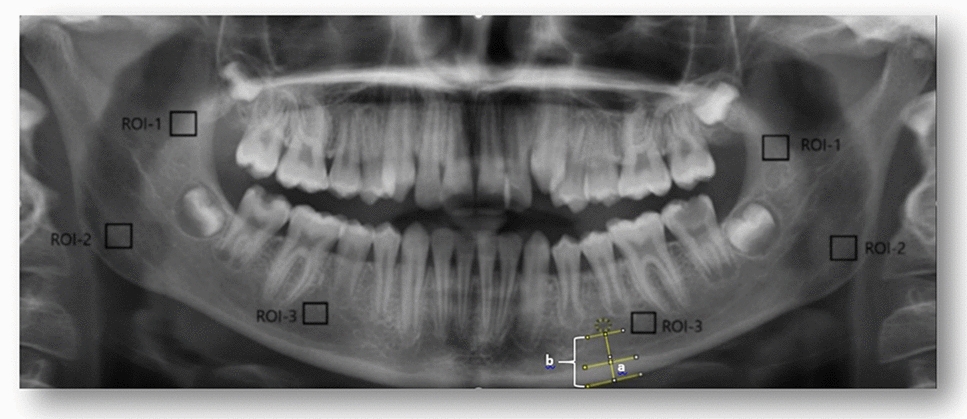 Evaluation of fractal analysis and radiomorphometric measurements of mandibular bone structure in bruxism and non-bruxism paediatric patients