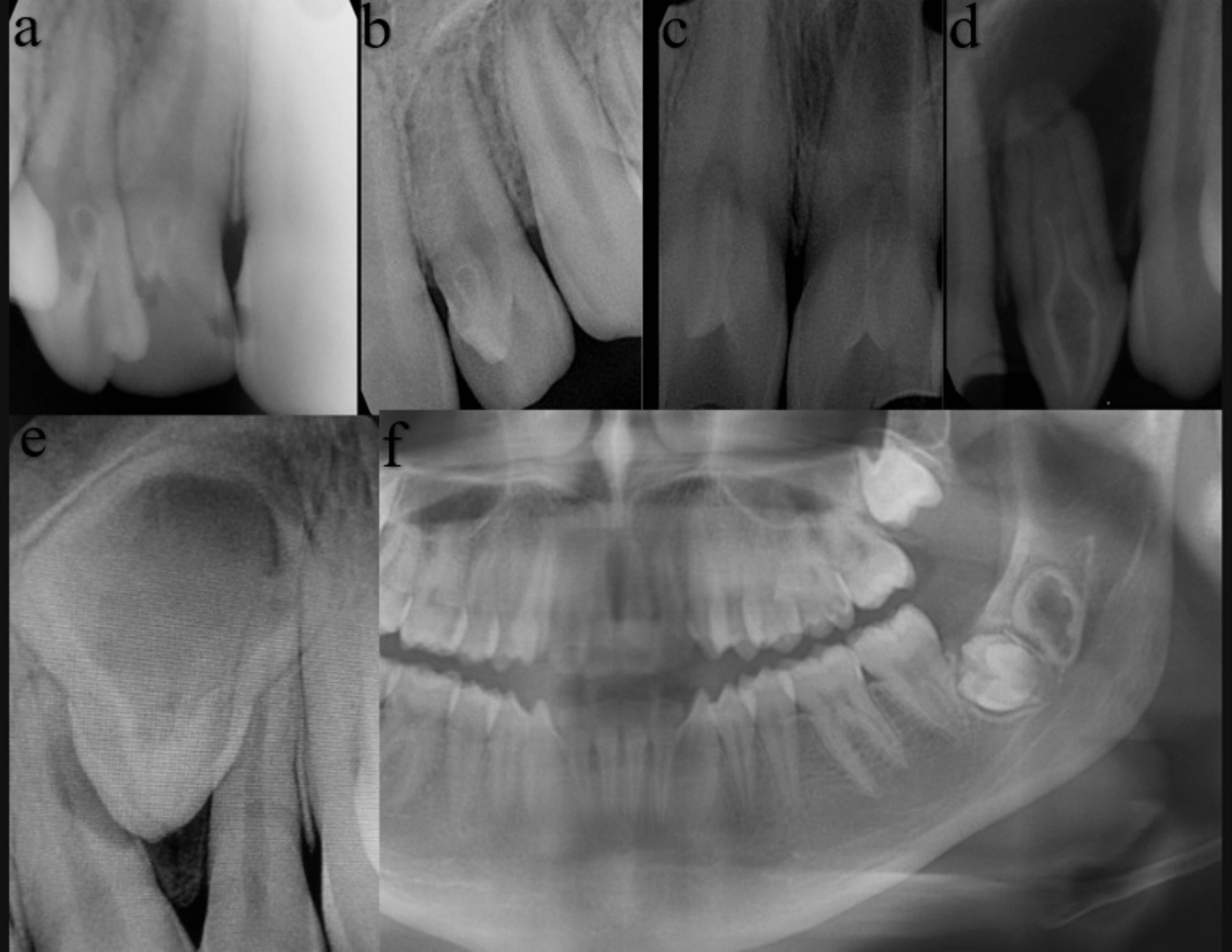 Radiologic evaluation of associated symptoms and fractal analysis of unilateral dens invaginatus cases