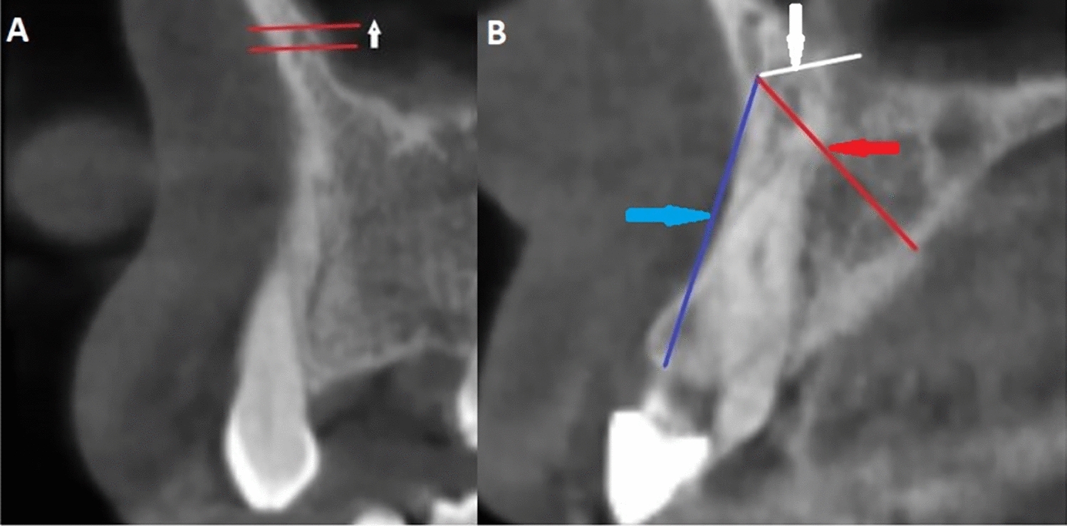 Evaluation of canalis sinuosus and accessory canal morphology by cone-beam computed tomography