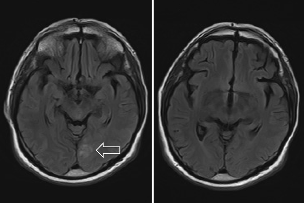 Amyloid-beta antibody treatment in Alzheimer’s disease