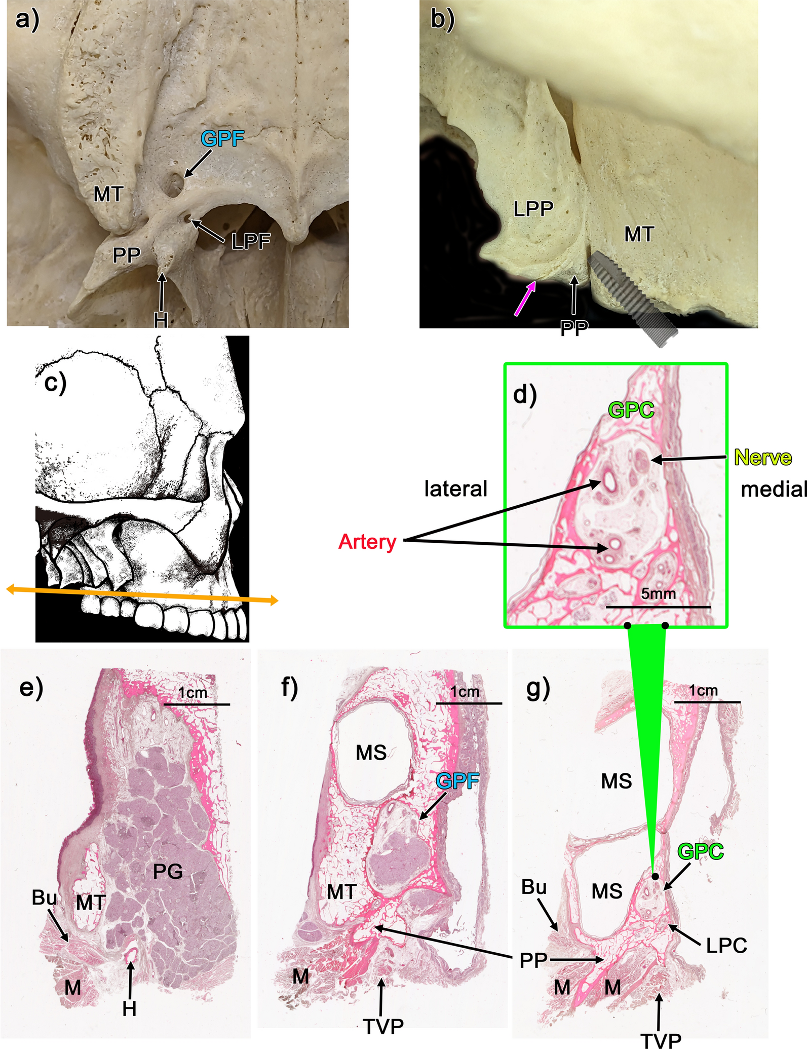 Anatomical study of pterygoid implants: artery and nerve passage through bone dehiscence of the greater palatine canal