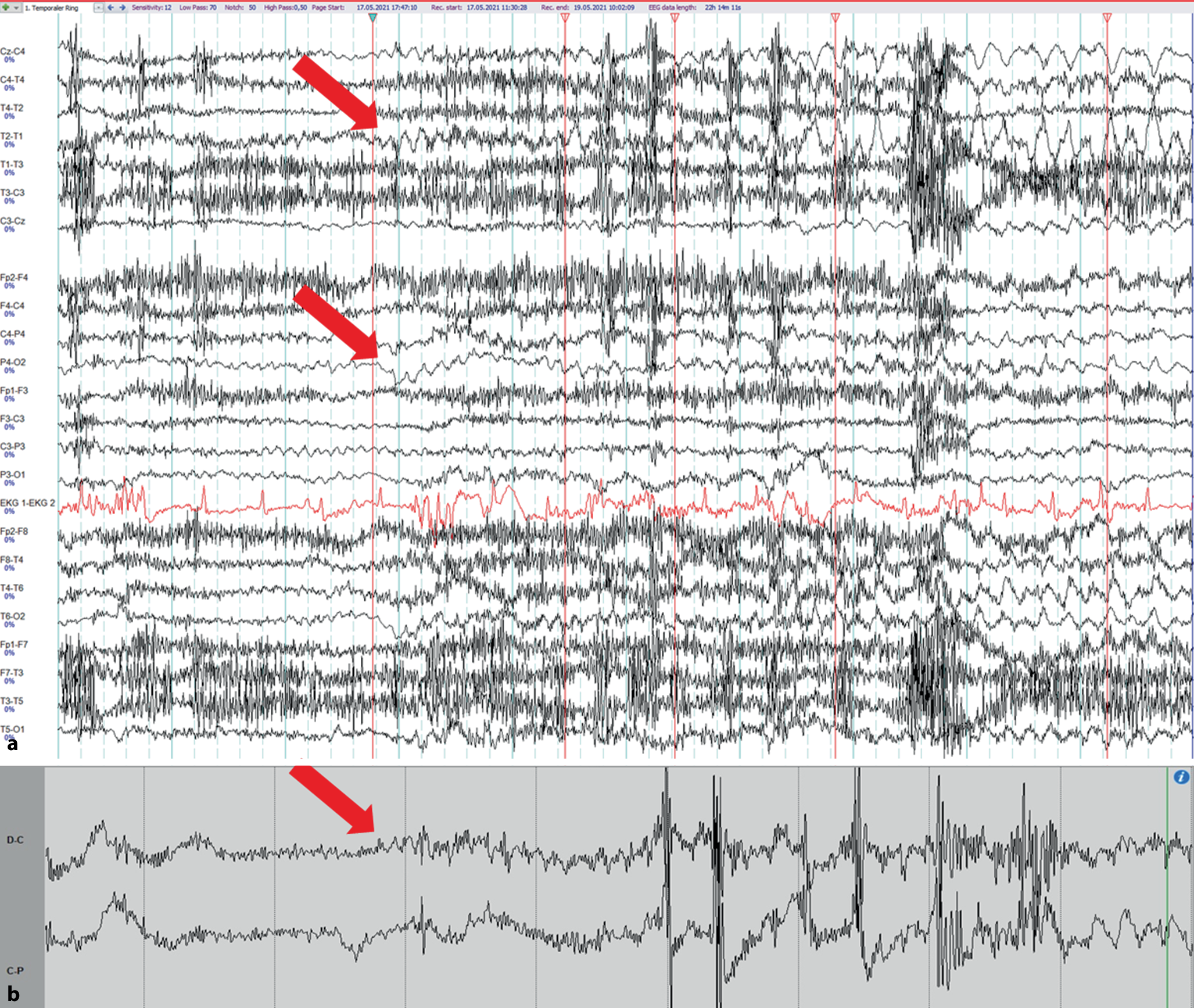 Detection of seizure clustering using ultralong-term subcutaneous EEG monitoring