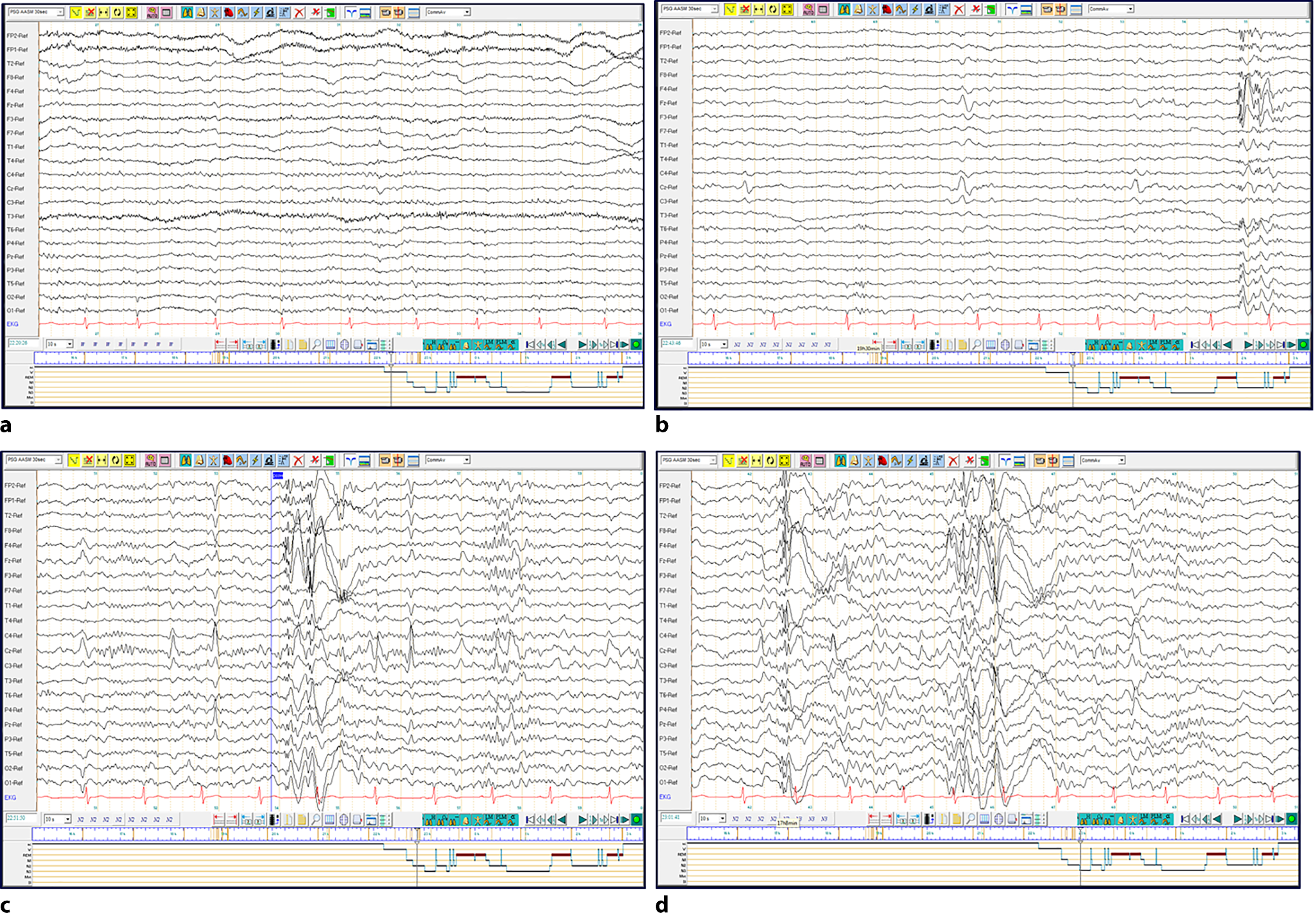 Epilepsie im Rhythmus der Nacht und im Zyklus des Schlafs