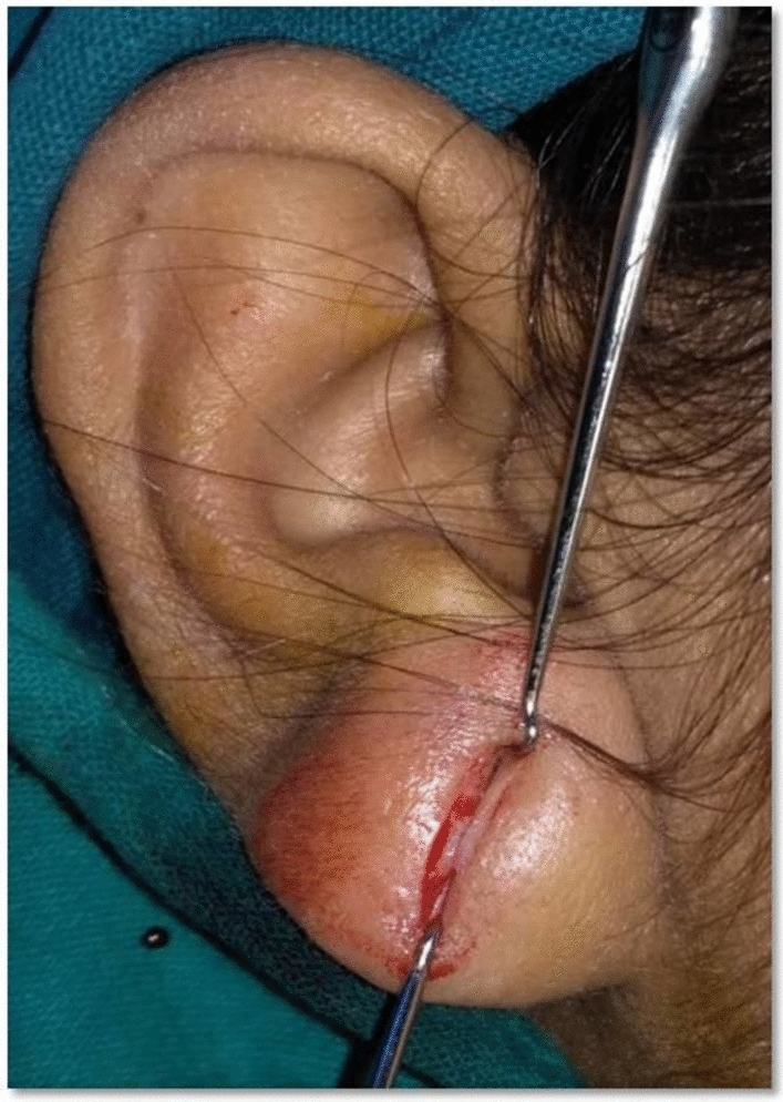 Comparative Evaluation of Bilateral Earlobe Cleft Repair with and Without Platelet Rich Plasma Injection- In vivo Randomized Study