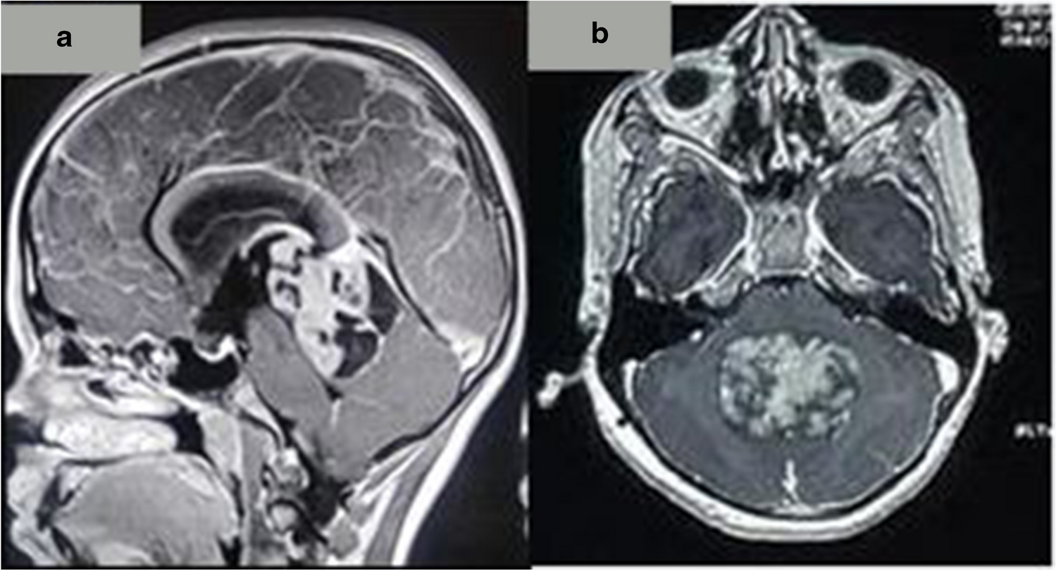 Pediatric Atypical Teratoid Rhabdoid Tumor of Central Nervous System: A Case Series with Review of Literature