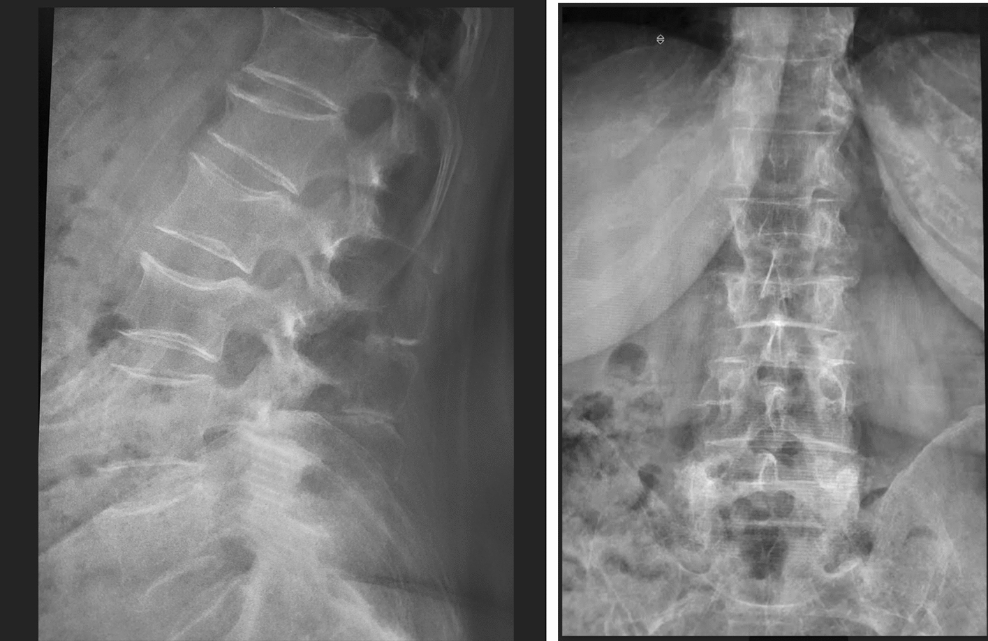 Fractures of the thoracolumbar spine in osteoporosis