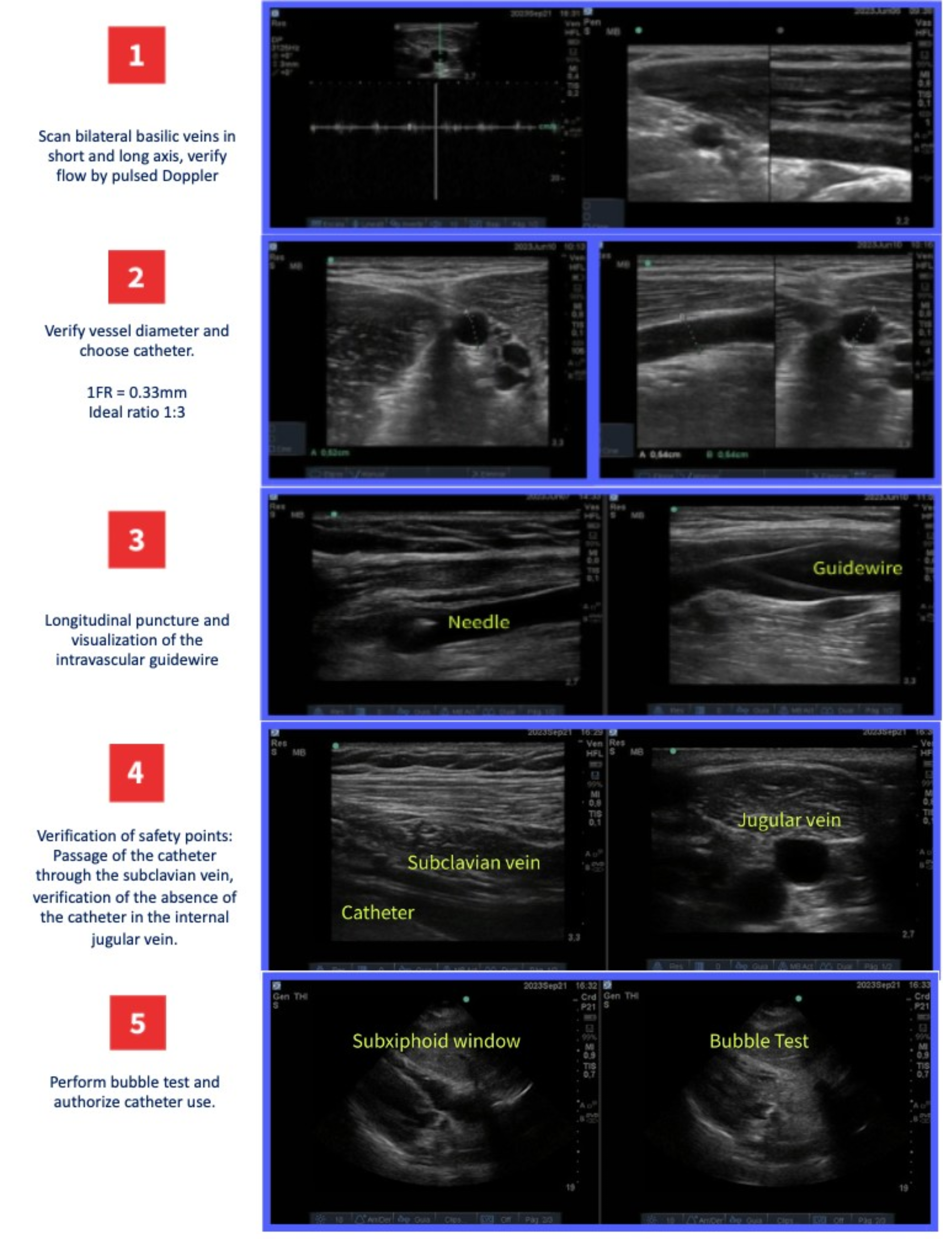 Experience of a vascular ultrasound-guided program: from the ICU to the hospital