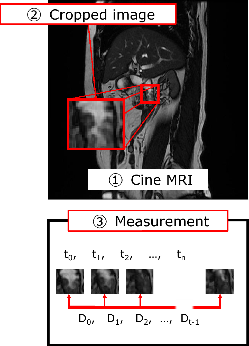 The effect on gastrointestinal peristalsis for magnetic resonance cholangiopancreatography during breath-holding methods