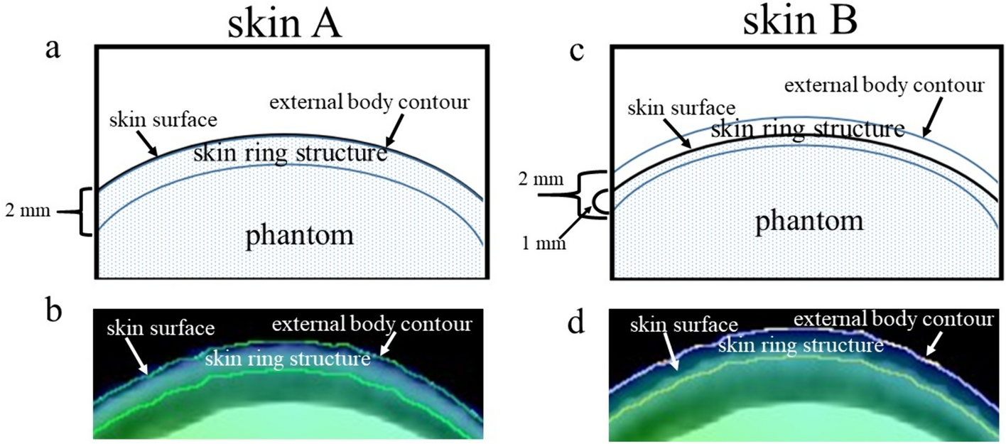 Optimum delineation of skin structure for dose calculation with the linear Boltzmann transport equation algorithm in radiotherapy treatment planning