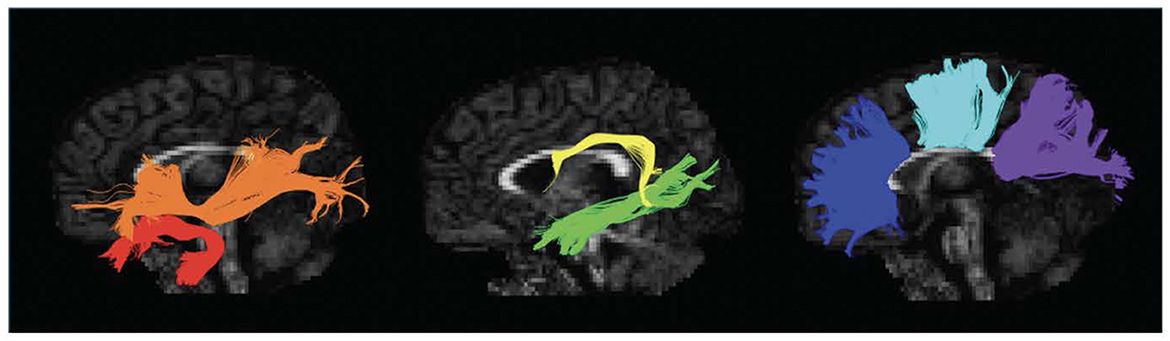 Prenatal tobacco and alcohol exposure, white matter microstructure, and early language skills in toddlers from a South African birth cohort