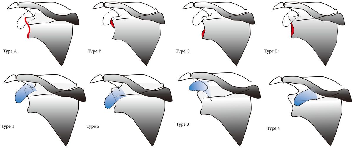 Possibility of diagnosing rotator cuff tears in areas with scarce medical resources: can non-standard anteroposterior radiographs accurately predict rotator cuff tears?